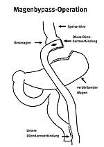 Skizze der Situation nach der Magenbypass-Operation