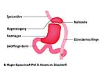 Magenbypass Magenbypass